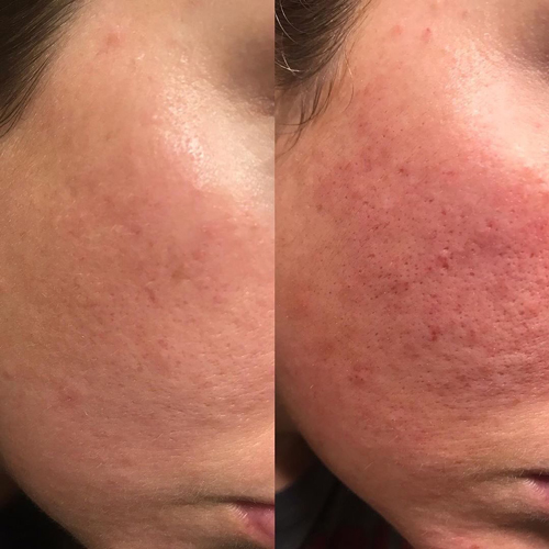 basic vi peel and dermasweep treatment at perceptions aesthetic spa in fairoaks and roseville, ca