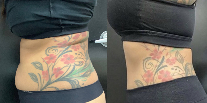 emsculpt treatment to abdomen before and after at perceptions aesthetic spa in fairoaks and roseville, ca