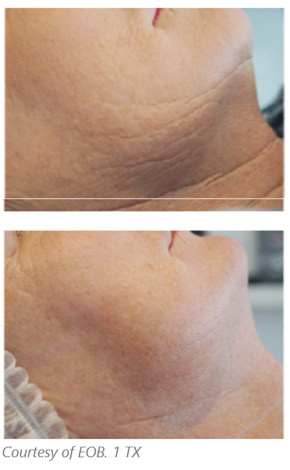 plasma pen neck wrinkles treatment at perceptions aesthetic spa in fairoaks and roseville, ca